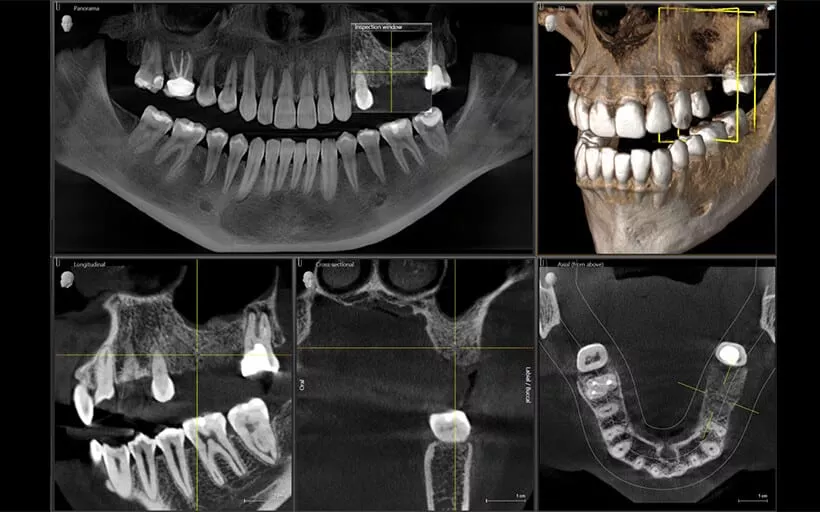 CBCT